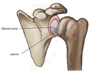 labrum tears shoulder