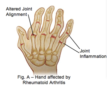 Rheumatoid Arthritis Anatomy